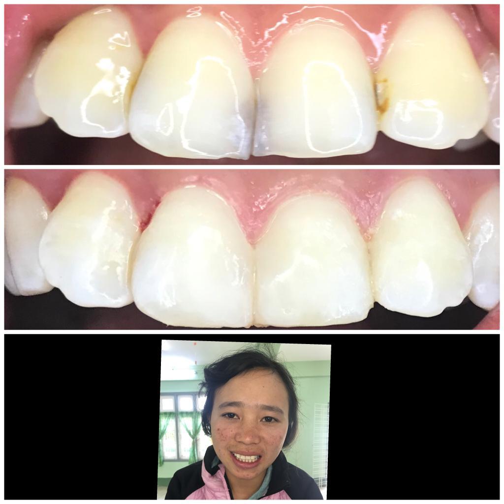 Myanmar -Charity-fix-teeh-decayed